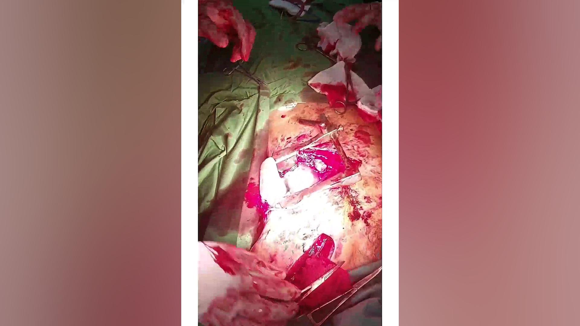 عمل جراحی چاقو خوردگی به قلب پلاسماجت