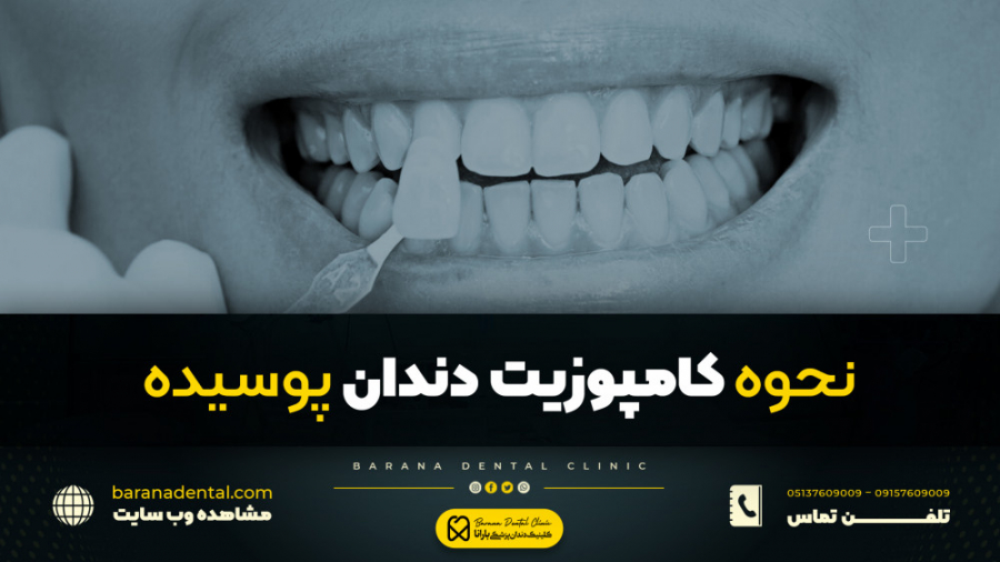 "نحوه کامپوزیت دندان پوسیده" بیماری آلبومینوری وراثتی