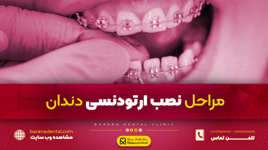 "مراحل نصب ارتودنسی دندان" Live Cell Microscopy