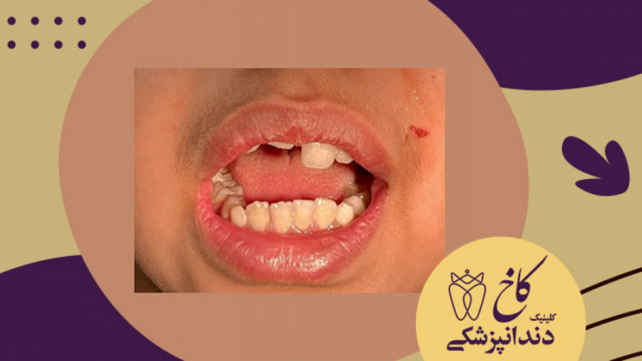 بالا آمدن قوس دندان های فک پایین مورد اورژانس ارتودنسی کلینیک دندانپزشکی کاخ