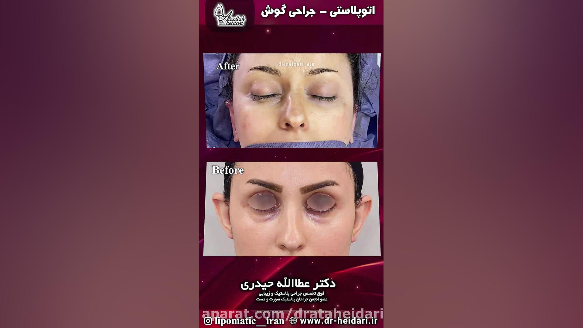 جراحی اتوپلاستی یا جراحی زیبایی گوش سیستم ارزیابی هیستوترمیک