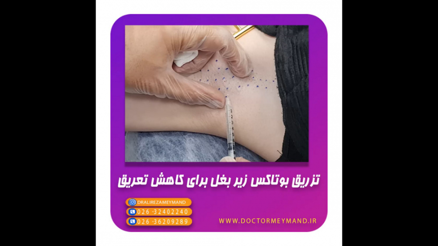 تزریق بوتاکس زیر بغل برای کاهش تعریق مطب تخصصی دکتر میمند دندان شیری