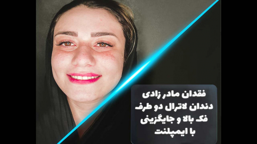 ایمپلنت دندان های نیش بیماری کلوتزوکس
