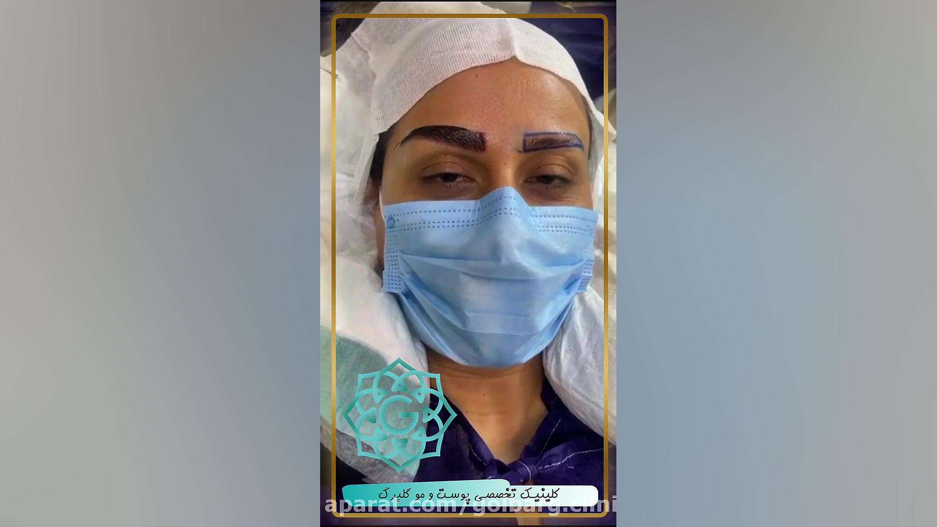 کاشت ابرو در کلینیک تخصصی پوست و مو گلبرگ بوشهر دندانپزشک زیبایی