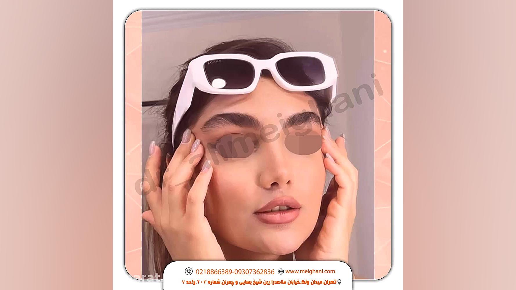 یک سال بعد از جراحی تیپ پلاستی بینی با بی حسی موضعی لیزر صورت
