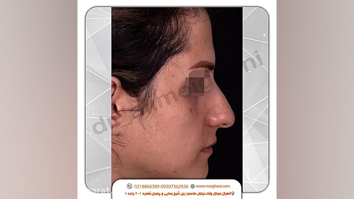 جراحی بینی طبیعی به روش تیپ پلاستی با بیحسی موضعی در بیمار عزیزمان از چین پروتز سینه