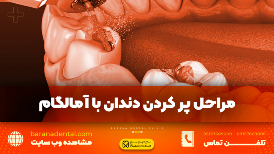 "نحوه پر کردن دندان با آمالگام به چه صورت است؟" پروتز سینه