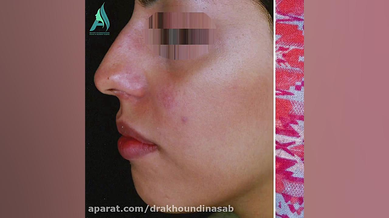 جراحی همزمان پروتز چانه و زیبایی بینی دکتر محمدرضا آخوندی نسب-فوق تخصص جراحی پلاستیک