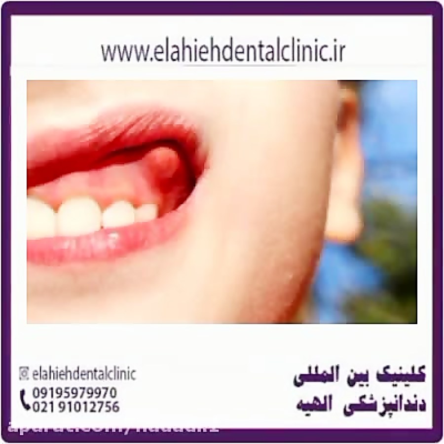 چرک خشک کن قوی برای عفونت لثه چرک خشک کن قوی برای عفونت لثه