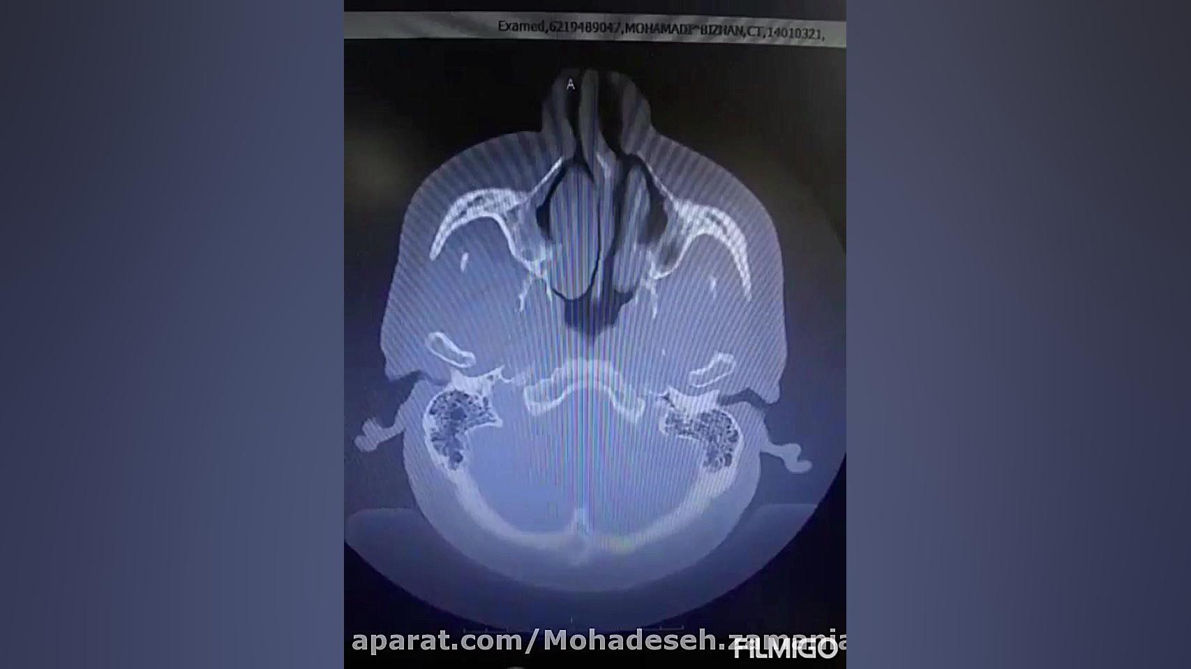 CTاسکن مغز نوموسفال وشکستگی فشاری جمجمه بیمار تروما اصلاح طرح لبخند