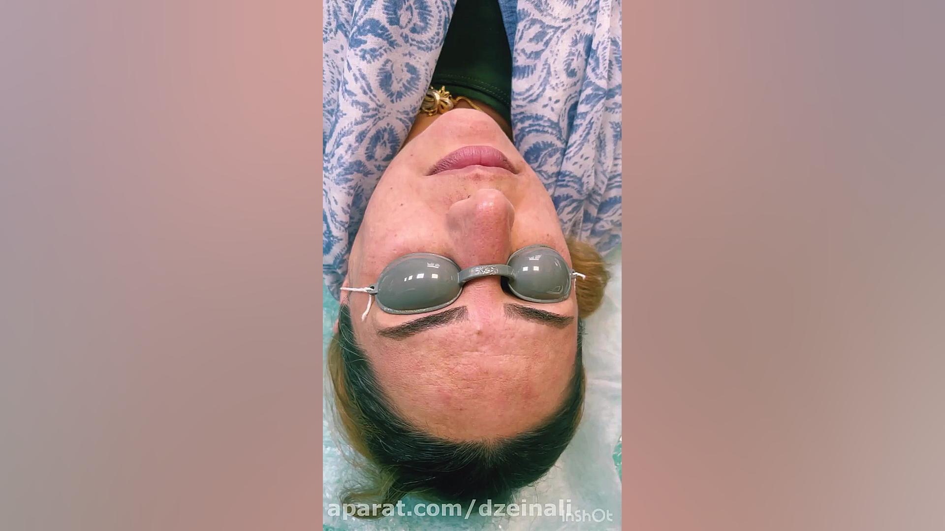 بهبود جالب لکهای پوستی با پیشرفته ترین لیزرهای لک دکتر فرحناز زینعلی - متخصص پوست، مو، زیبایی زنجان
