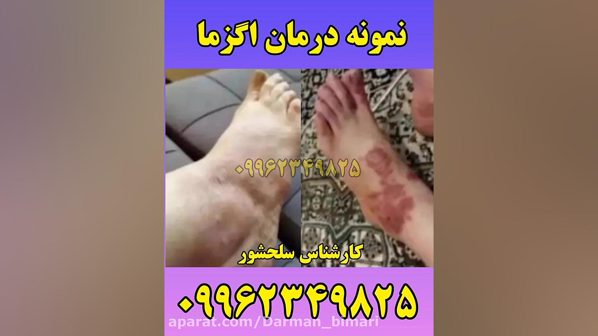 نمونه درمان اگزما پوستی کاملا تضمینی پسر آبجی