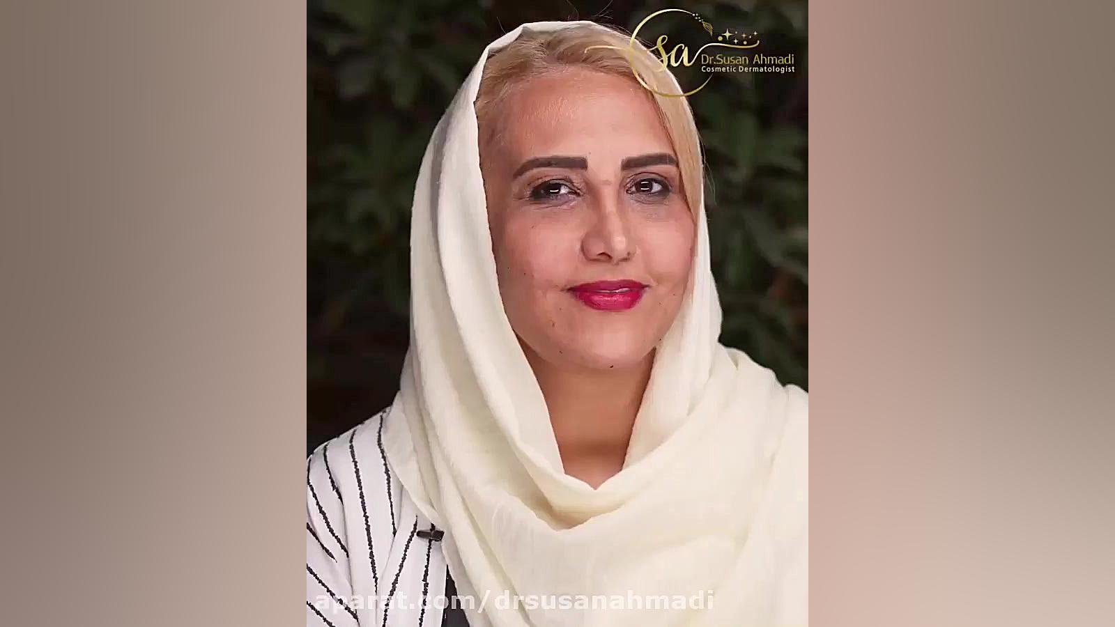 فیلم رضایت مراجعه کننده از تزریق چربی دکتر سوسن احمدی پیر شهید