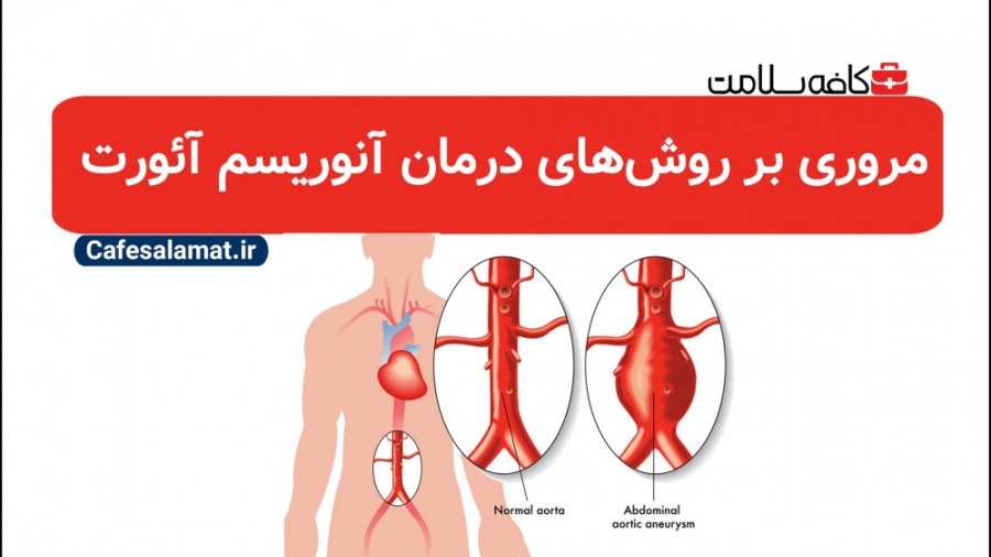 مروری بر روش‌های درمان آنوریسم آئورت کلینیک دندانپزشکی