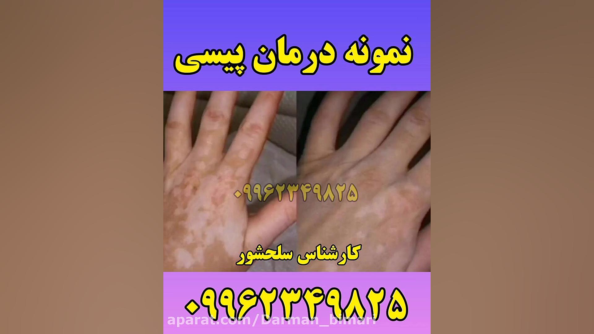 نمونه درمان پیسی(ویتیلیگو) کاملا تضمینی هایفوتراپی