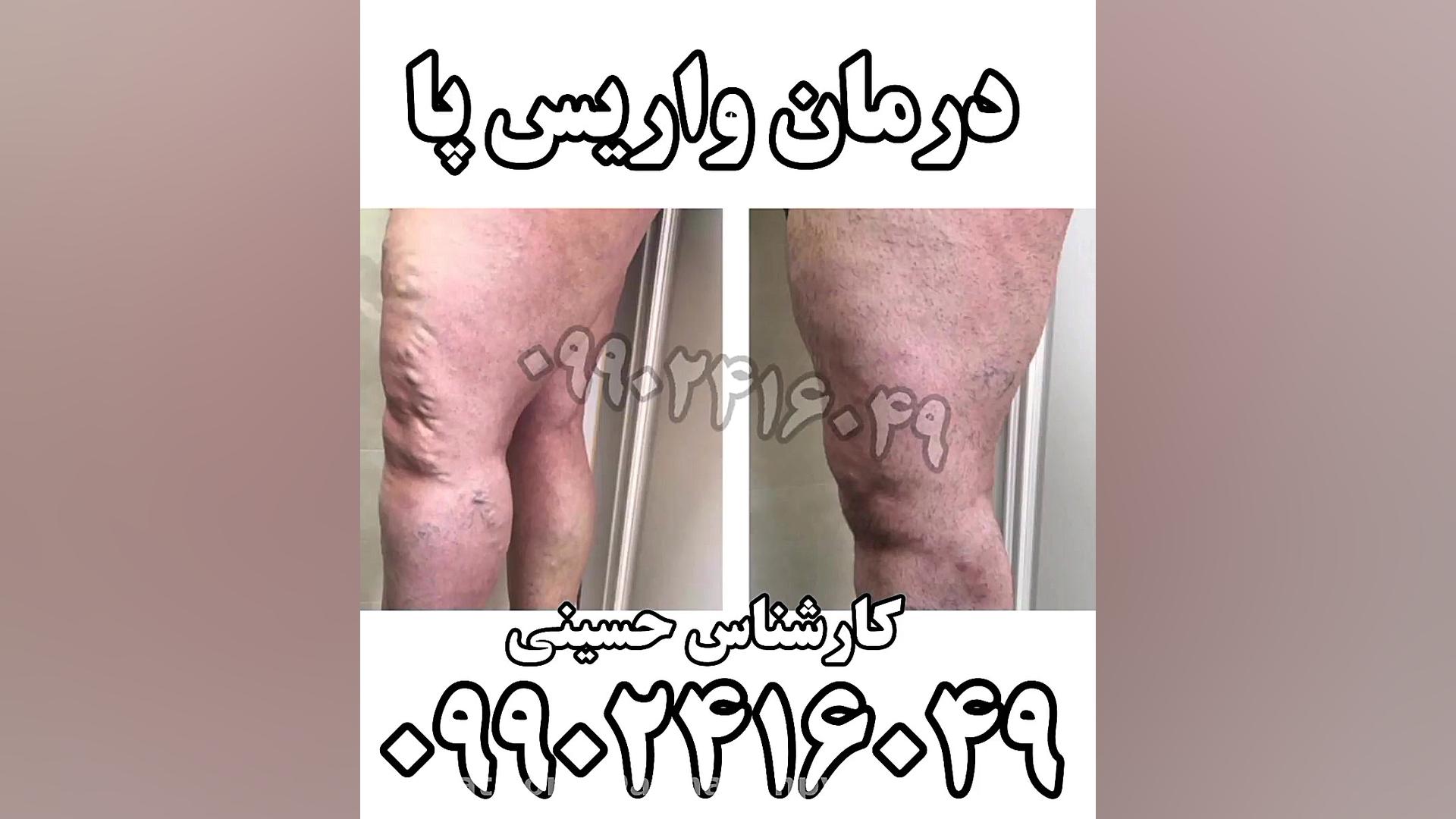 درمان واریس (واریکوسل) بیماری پولی‌آرتریت ندوزا