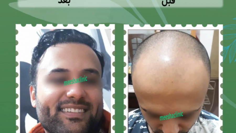 کاشت مو طبیعی کلینیک میشا (دکتر سید حسن حسینی)