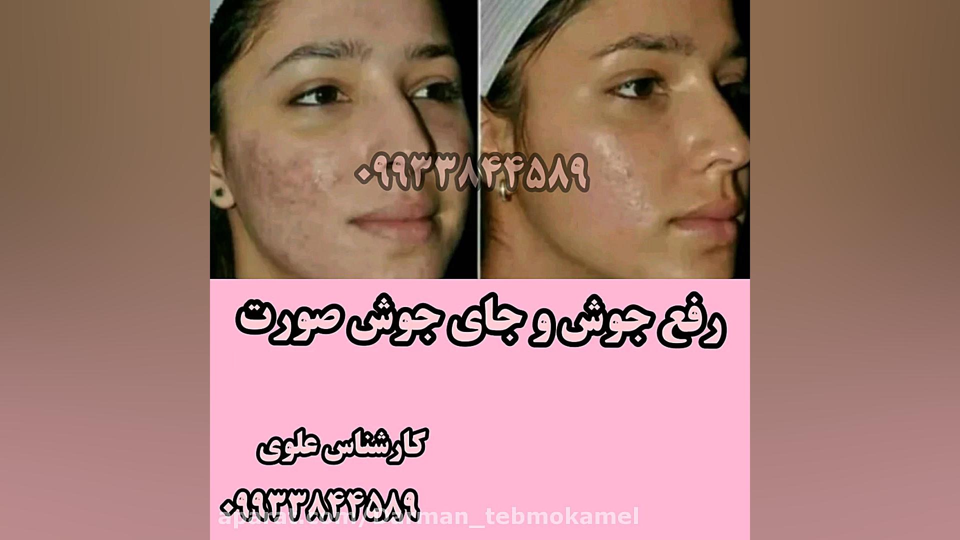 بهبودی جوش کربوکسی تراپی