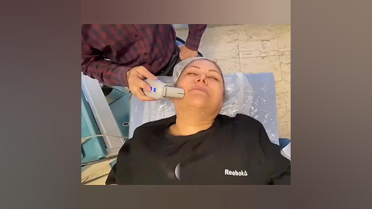 هایفوتراپی صورت جهت لیفت صورت و جوانسازی پوست کلینیک شریعتی بیماری پورفیری اریتروپوئتیک