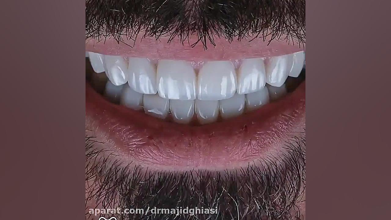 اصلاح طرح لبخند دستگاه فیبر نوری جراحی