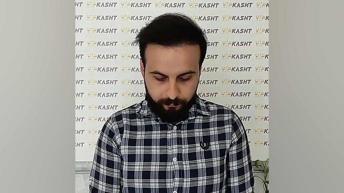 نگاهی از گذشته تا امروز کاشت مو- کلینیک vip تهران مگالودکس