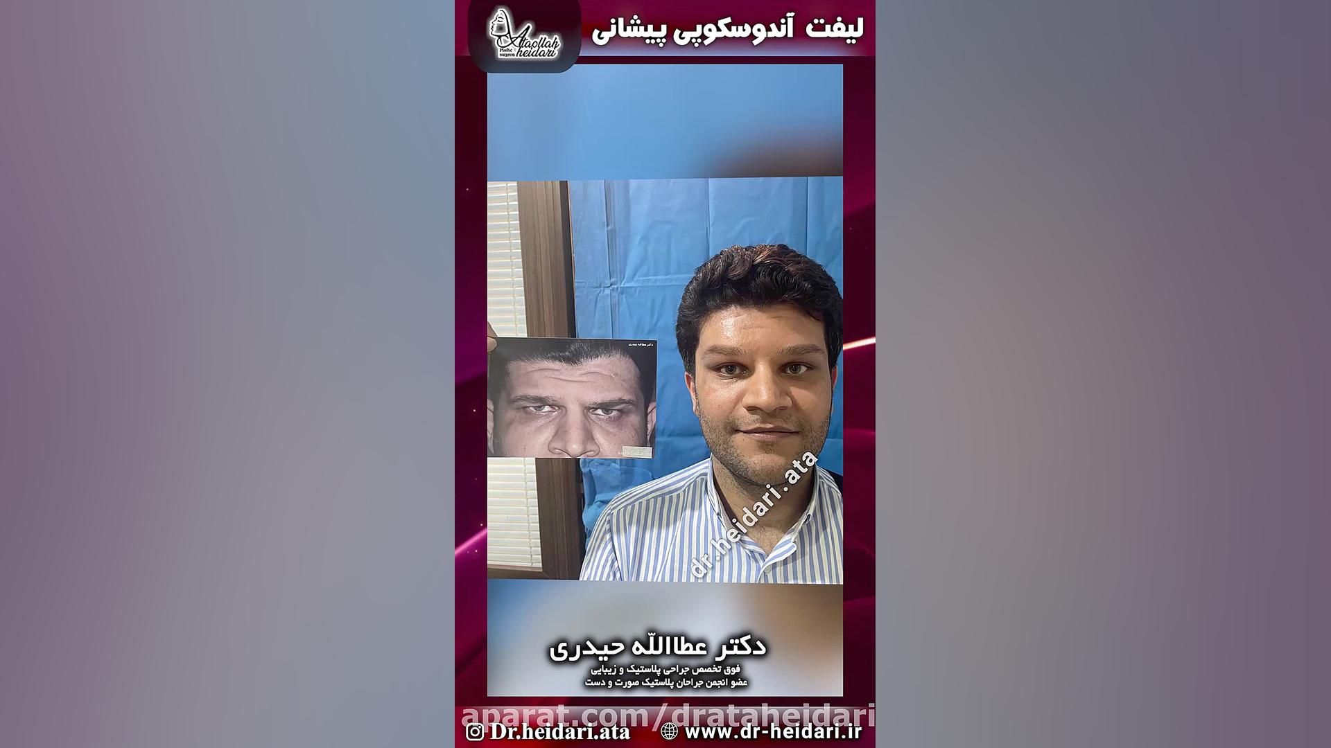 لیفت آندوسکوپی پیشانی الکترود اپتوژنزی