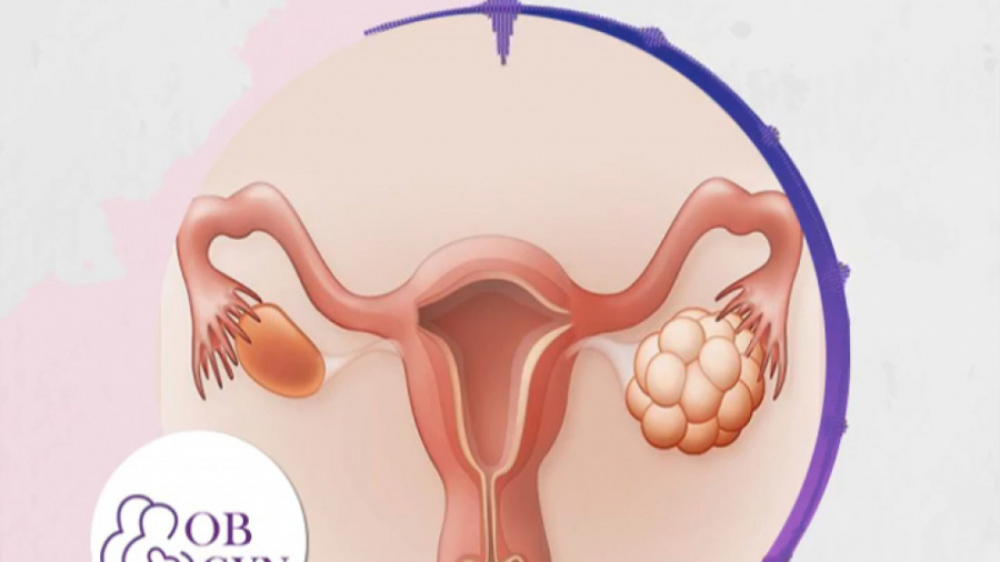 سندروم تخمدان پلی کیستیک یا تنبلی تخمدان چیست؟ تزریق بوتاکس