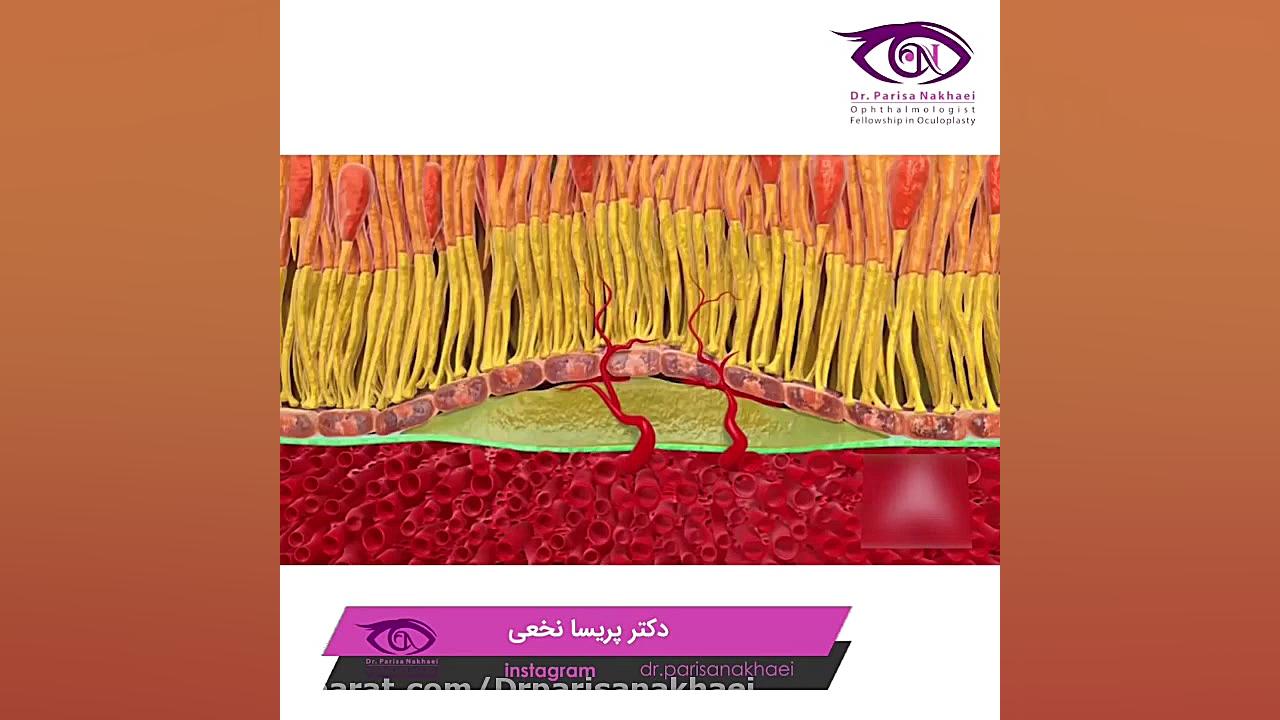 بیماری مرکز بینایی(ماکولا) در اثر ایجاد عروق نابجا اکتروپیون
