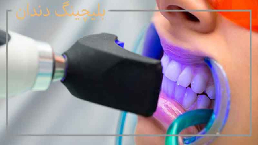 فرآیند انجام بلیچینگ در مطب لیپوماتیک