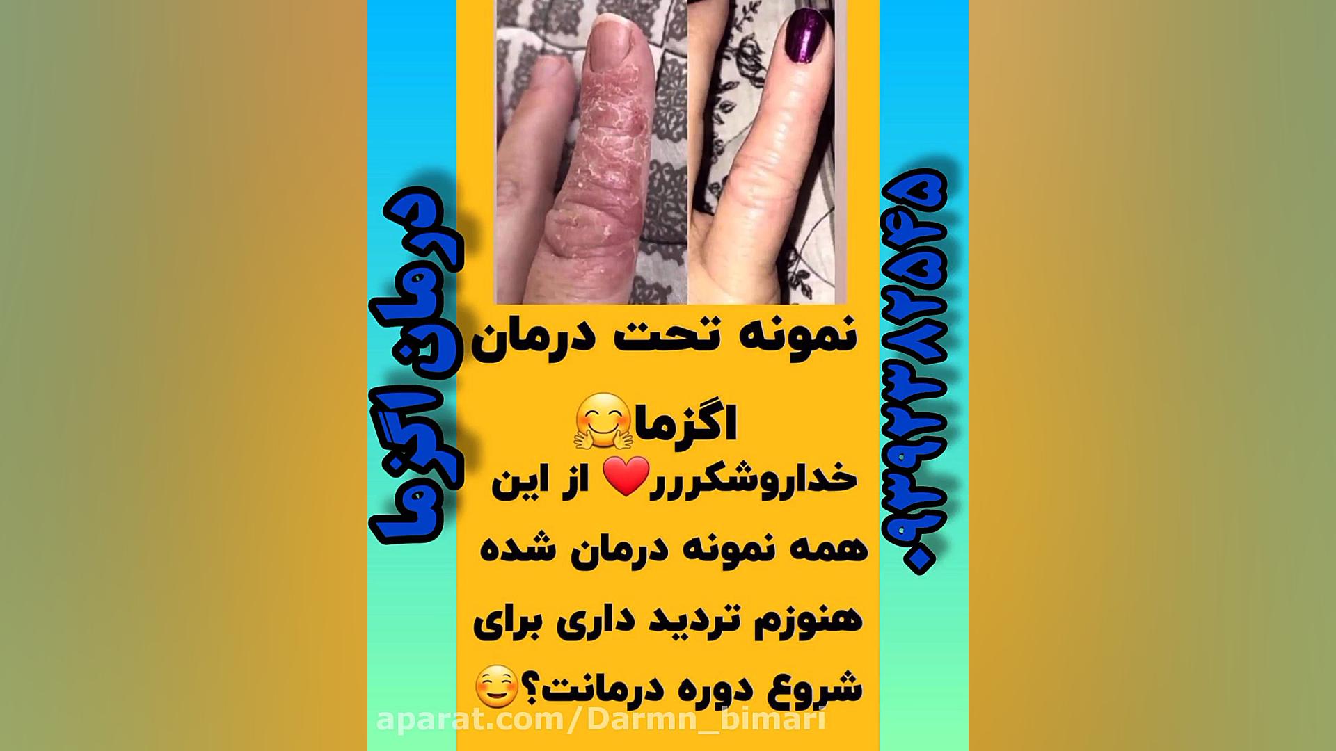 درمان اگزما کاتاپلکسی