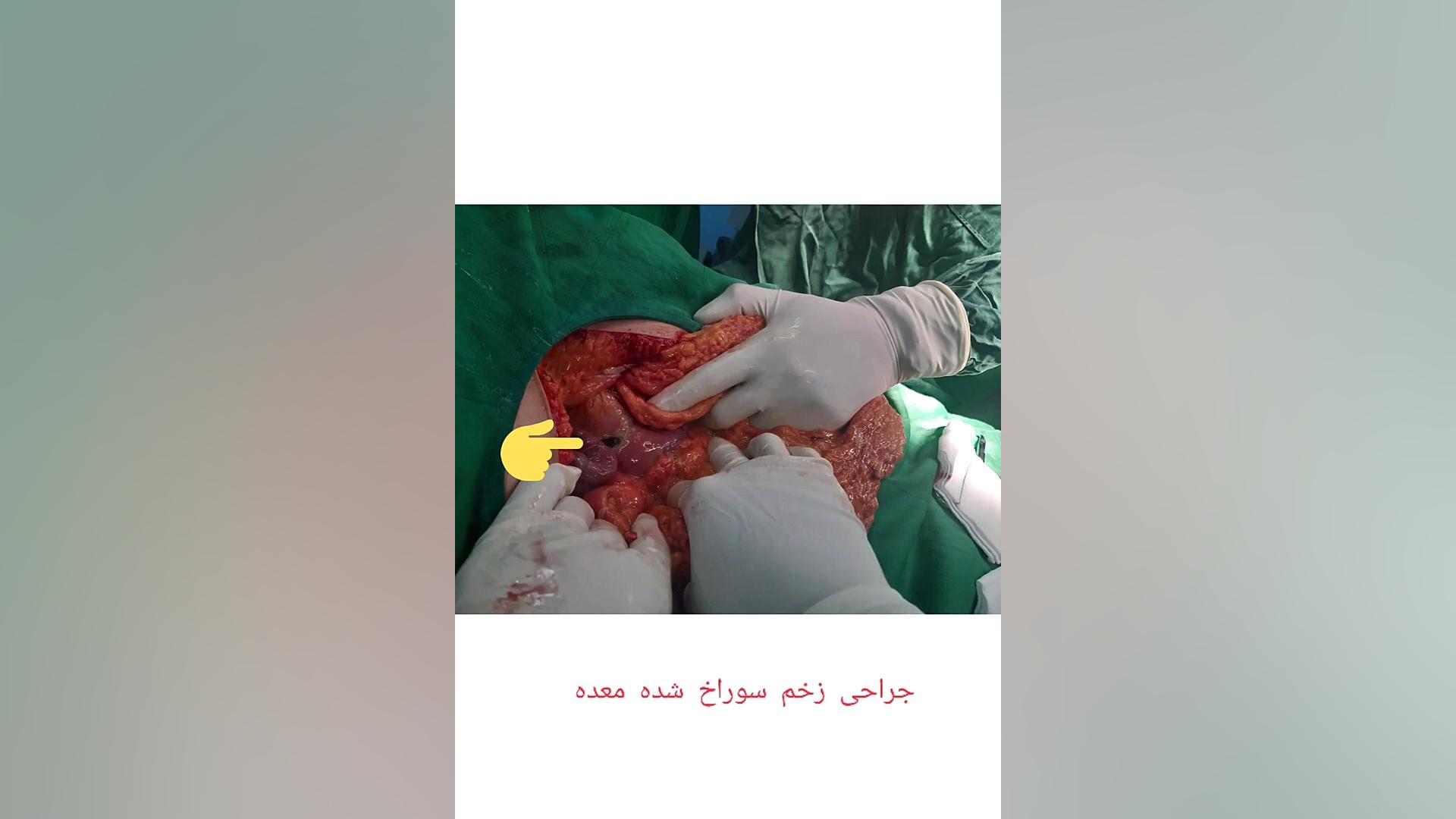 جراحی زخم معده سوراخ شده برداشتن زگیل