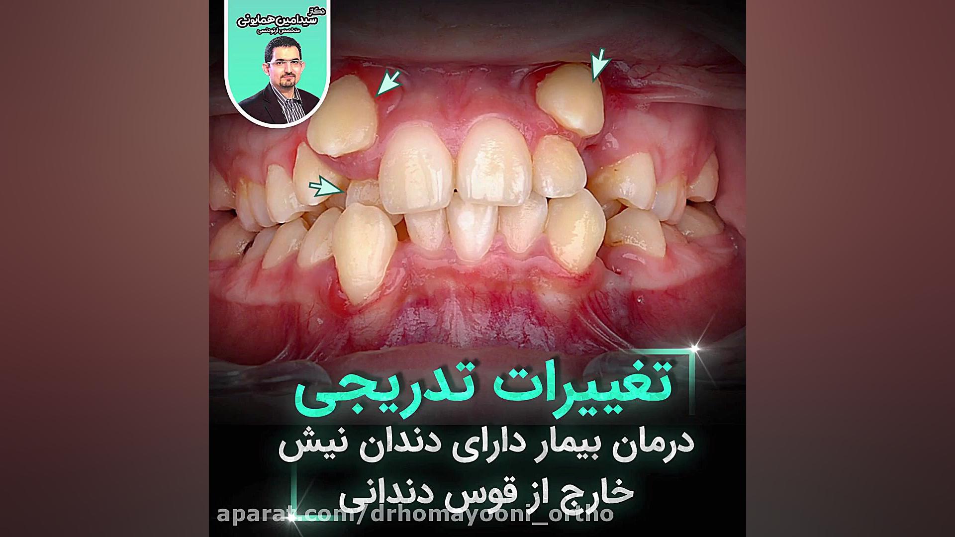 تغییرات تدریجی درمان بیمار دارای دندان نیش خارج از قوس دندانی کاپوت سکودانئوم