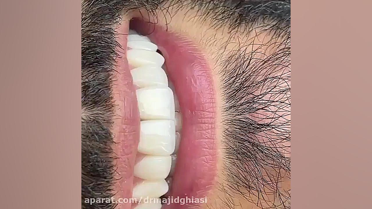 ترمیم پوسیدگی دندان دکترمجیدقیاسی