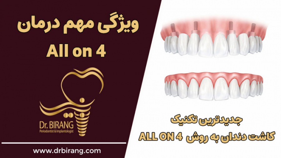 ویژگی مهم درمان all on 4 | دکتر احسان بیرنگ متخصص کاشت ایمپلنت به روش دیجیتال دکتر احسان بیرنگ