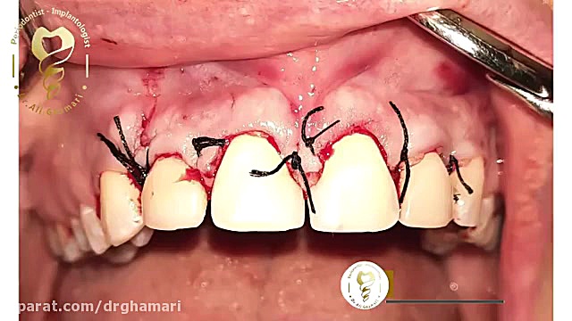جراحی لبخند لثه ای برداشتن خال