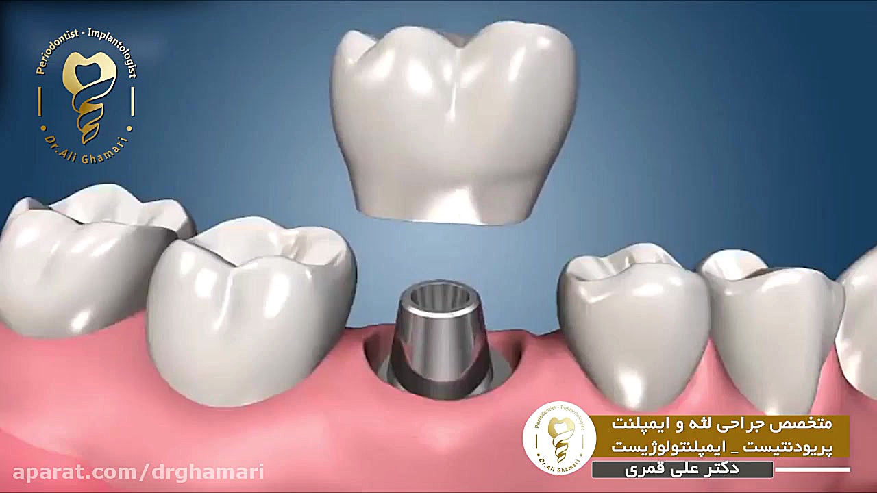 در يك جلسه چند ایمپلنت می توان انجام داد؟ دکتر علی قمری - متخصص جراحی لثه و ایمپلنت