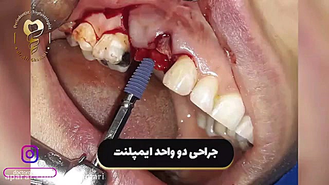 ️جراحی ۲ واحد ایمپلنت ️ دکتر علی قمری - متخصص جراحی لثه و ایمپلنت