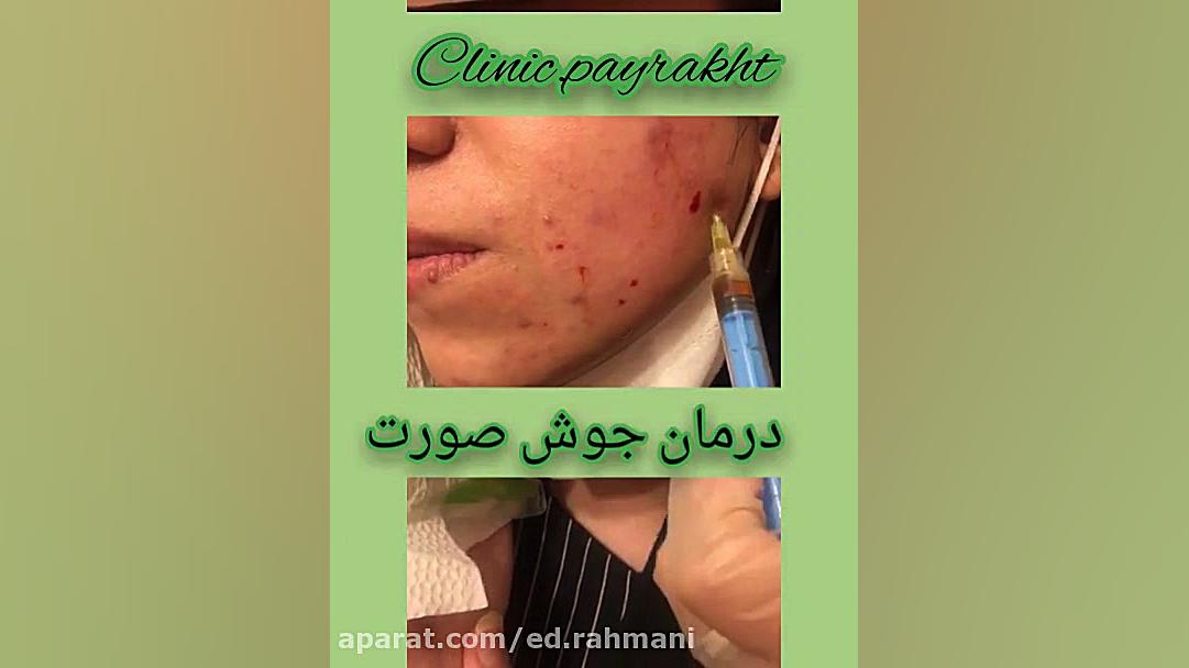 مزو تراپی اصلاح طرح لبخند