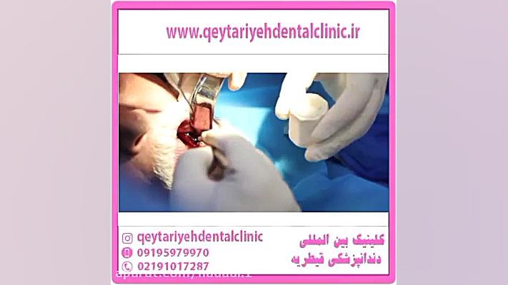 همه چیز در خصوص جراحی فک پزشکی کانابینوئید