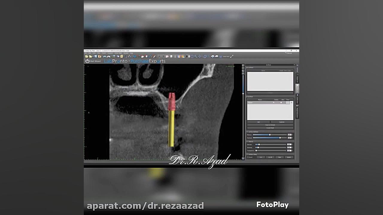 دکتر رضا آزاد: جراحی های پیشرفته ایمپلنت دندانی، Advance Implant دکتر رضا آزاد