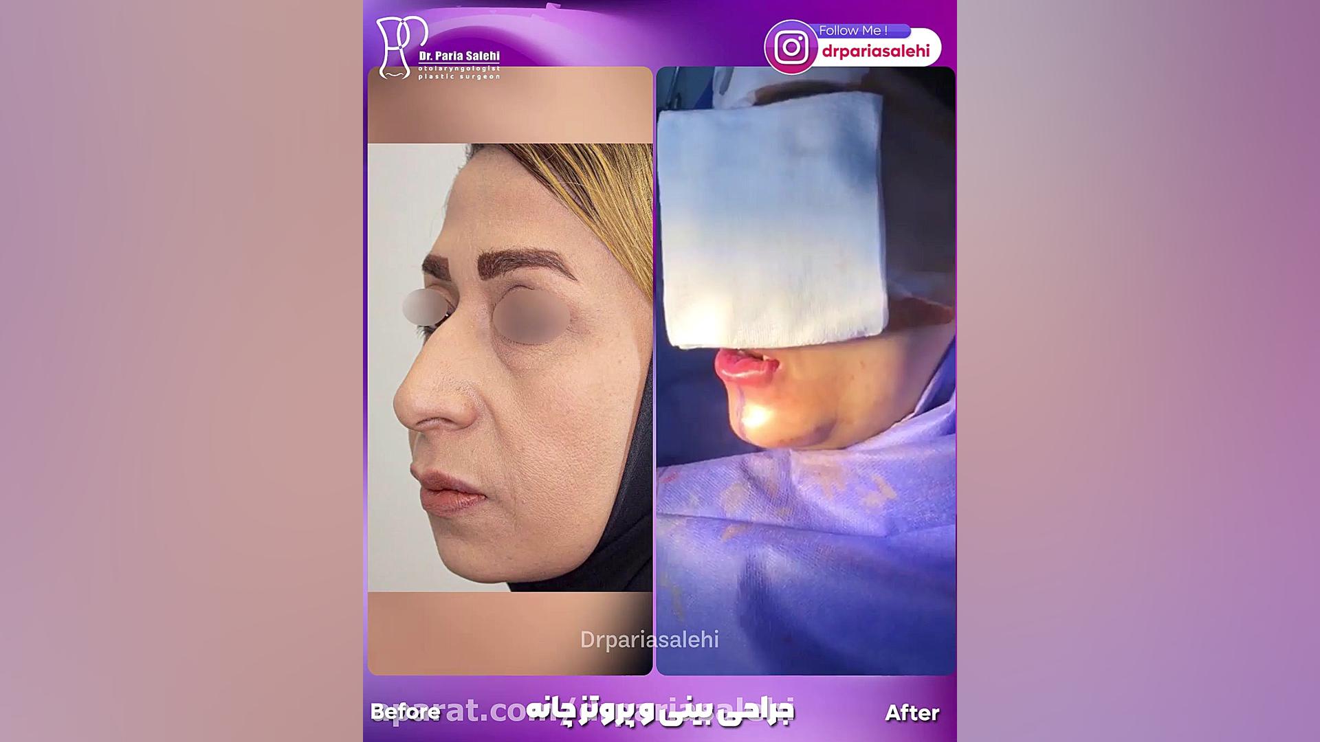 جراحی بینی همراه با پروتز چانه دکتر پریا صالحی ✔ بهترین جراح بینی تهران