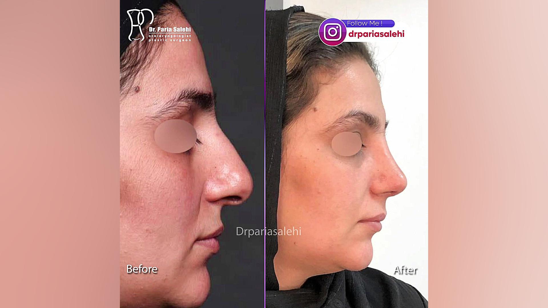 جراحی زیبایی بینی با نوک پهن دکتر پریا صالحی ✔ بهترین جراح بینی تهران