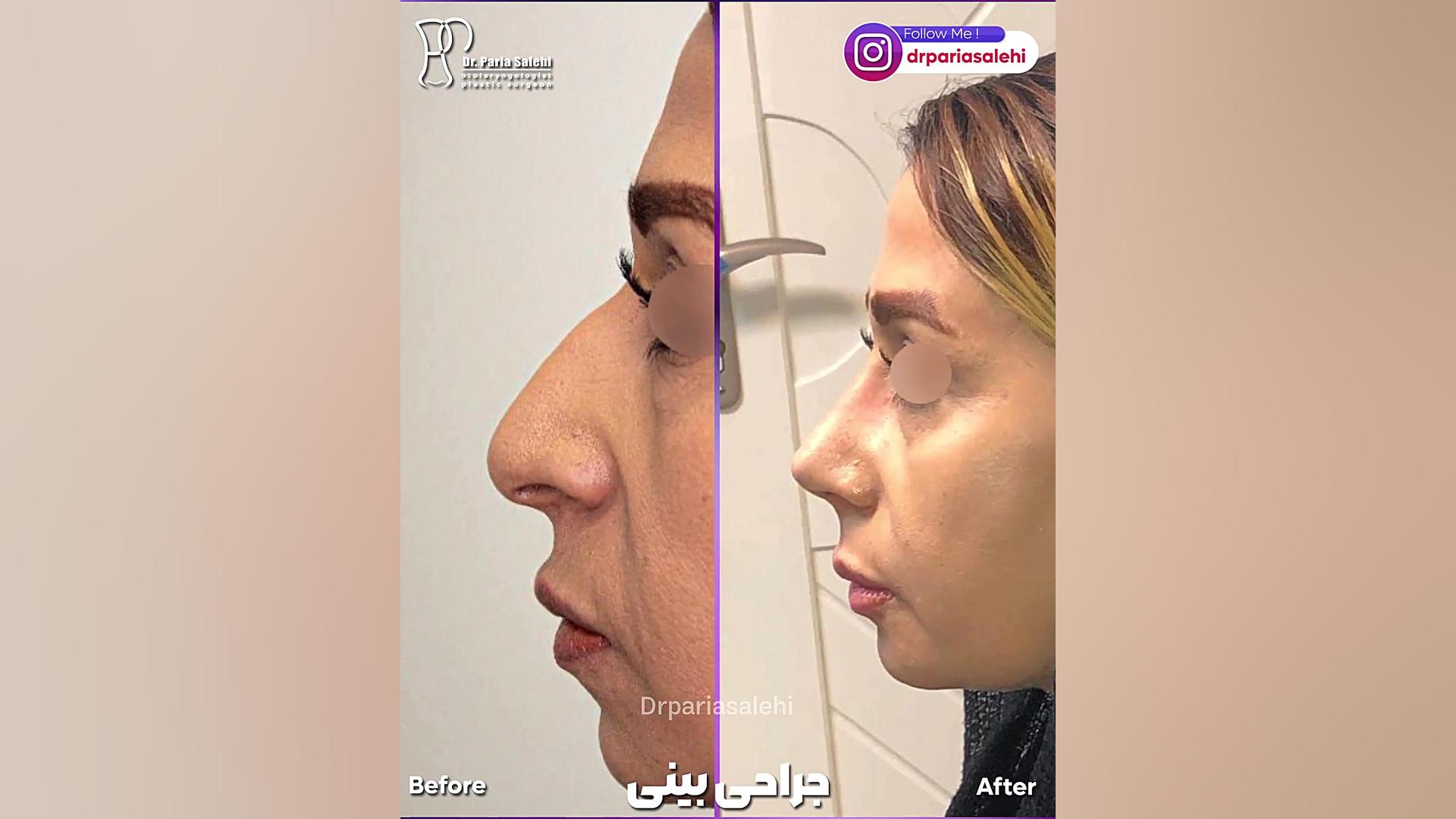 جراحی زیبایی بینی با قوس کم دکتر پریا صالحی ✔ بهترین جراح بینی تهران