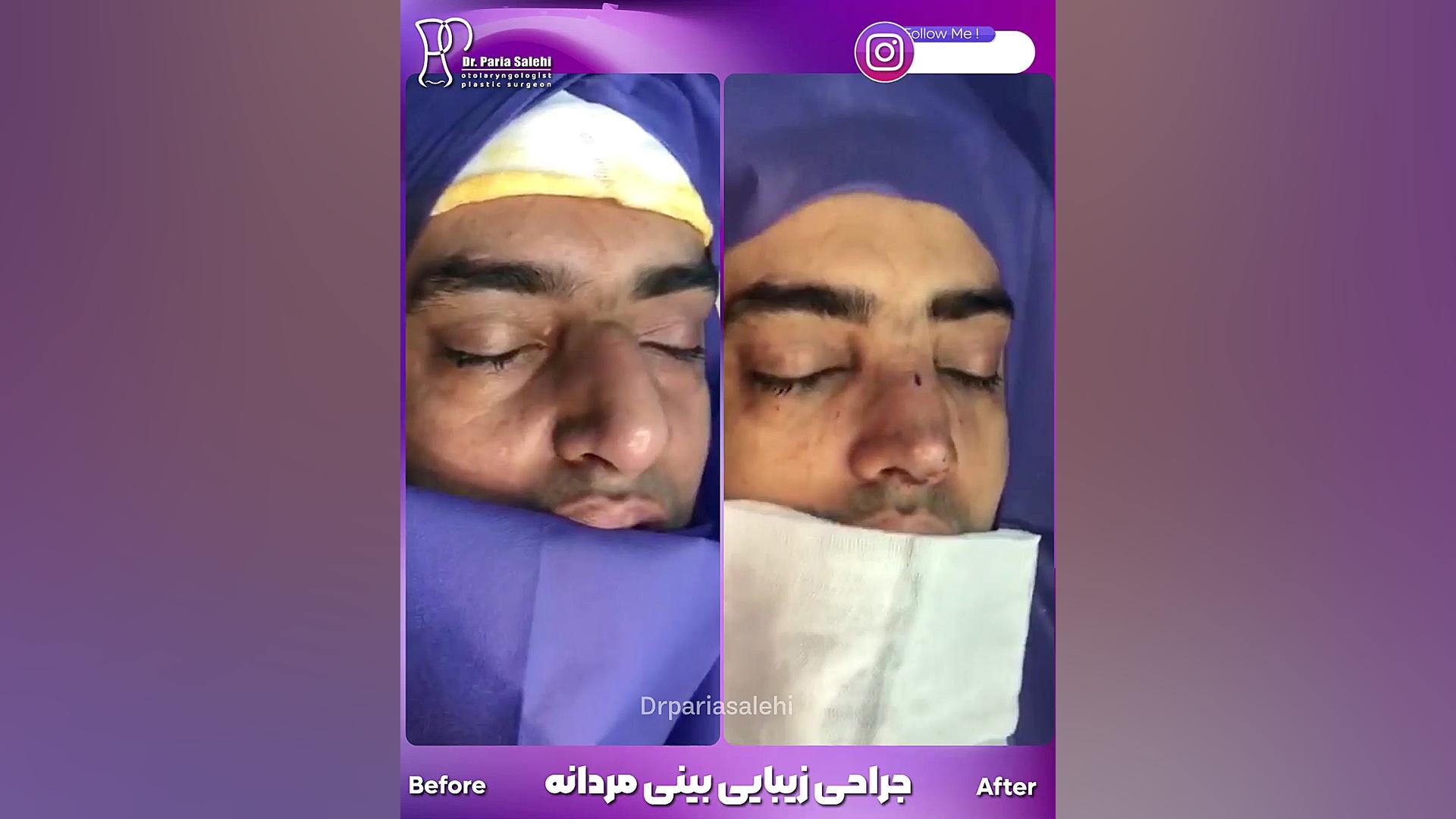 جراحی بینی طبیعی مردانه دکتر پریا صالحی ✔ بهترین جراح بینی تهران