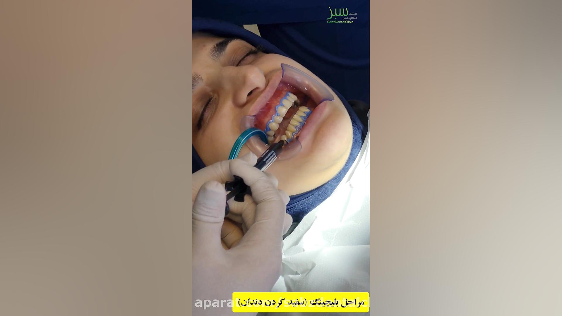 مراحل آفیس بلیچینگ دندان (سفید کردن دندان) بررسی لک صورت