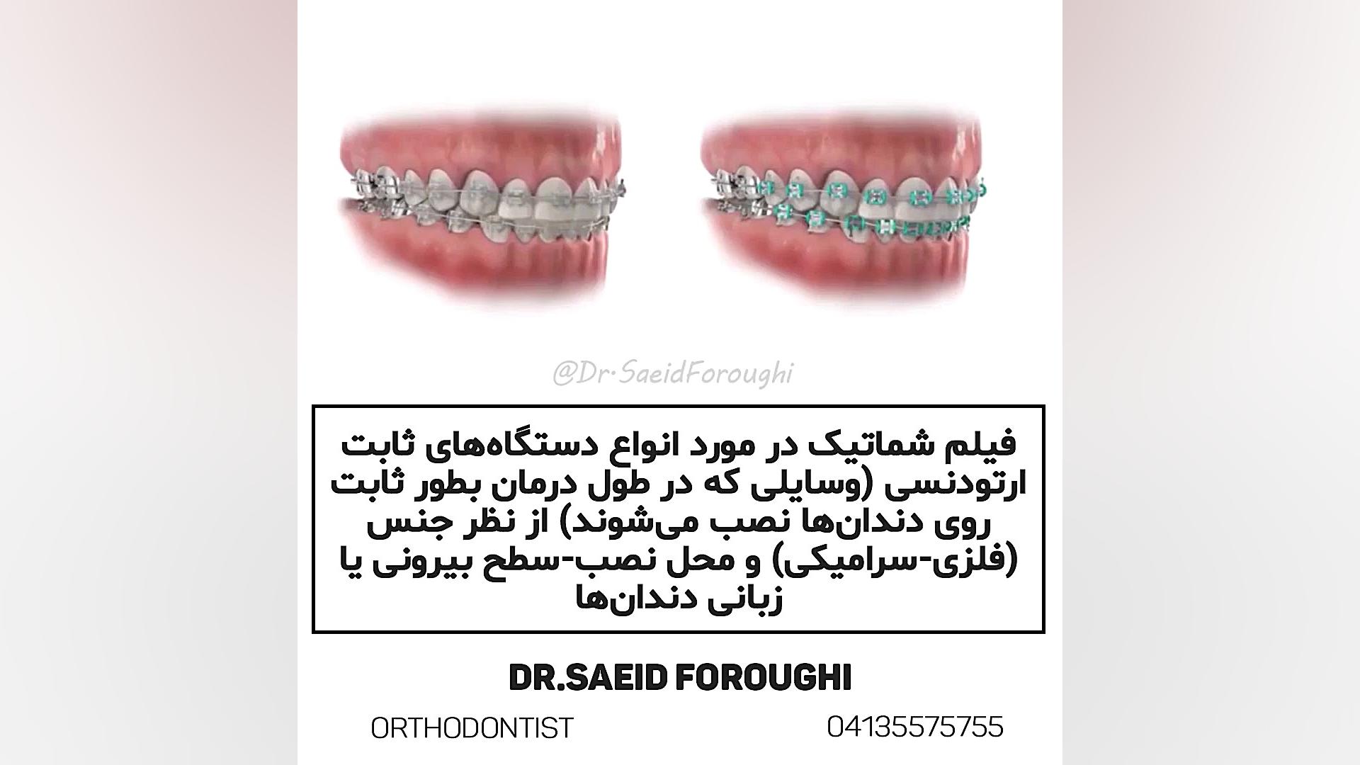 دستگاههای ثابت ارتودنسی دکتر سعید فروغی متخصص ارتودنسی