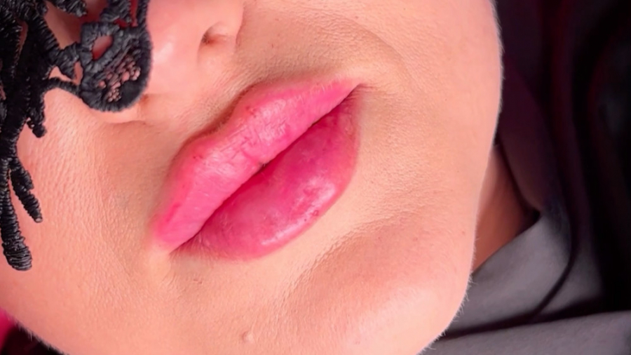 تزریق ژل لب روسی با متد جدید روسی ۲۰۲۲ کلینیک زیبایی رشت دکتر مهدیه حسین زاده