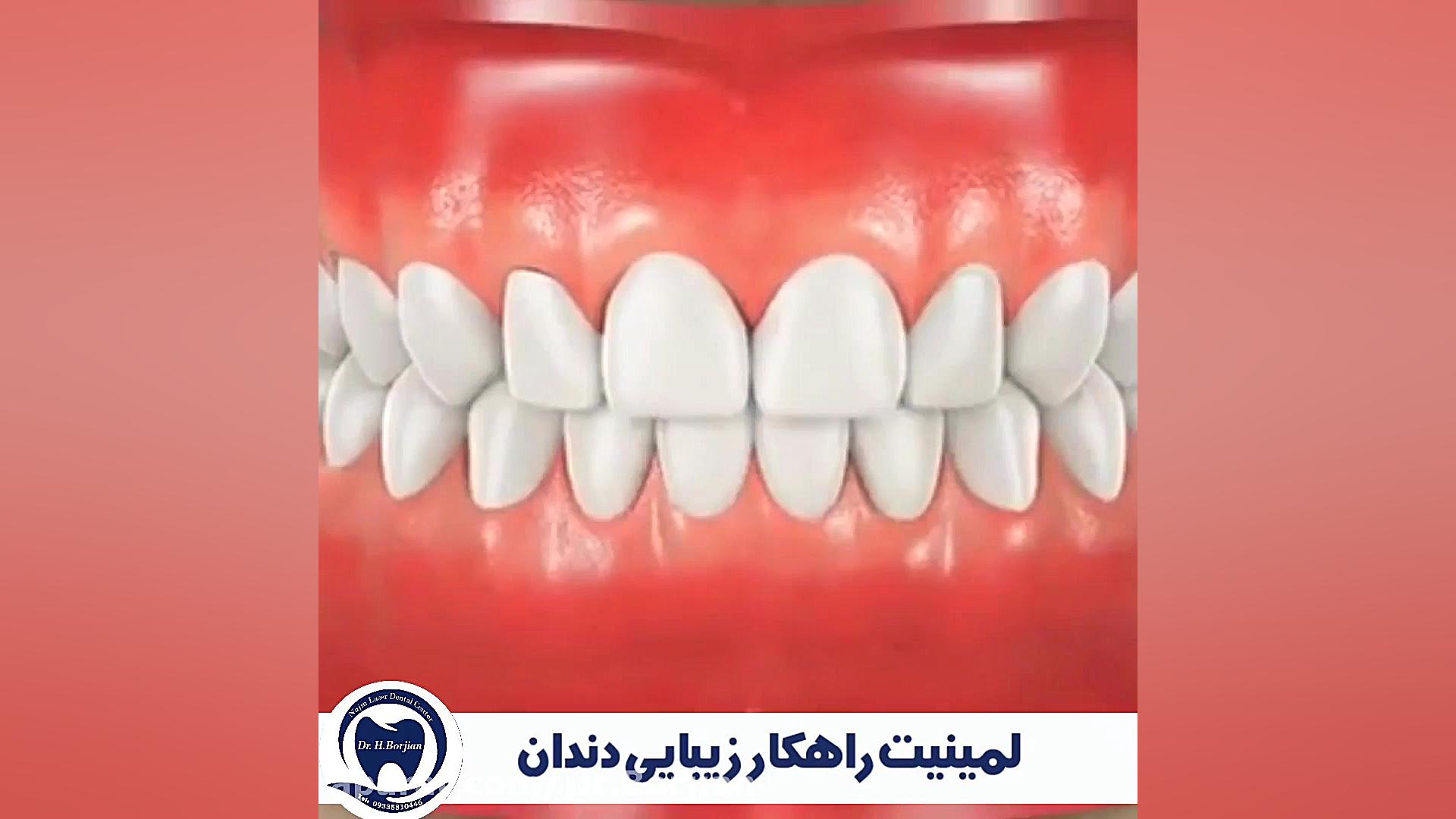 لمینیت راهکار زیبایی دندان - بهترین دندانپزشک زیبایی اصفهان بیماری آلبومینوری وراثتی
