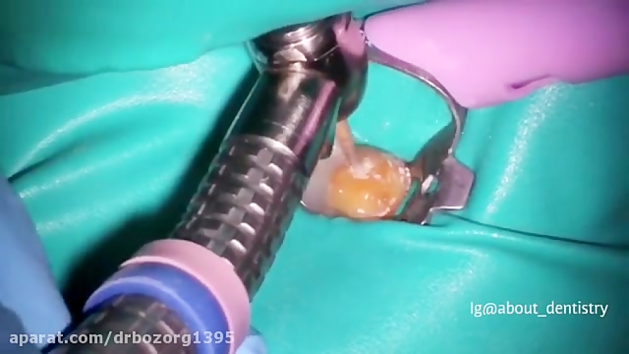 ترمیم دندان ریبوسیکلیب