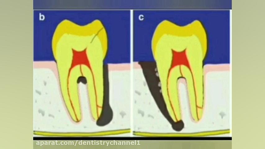 مبحث بیماری های مشترک اندو پریو آوتوپلیسوماب